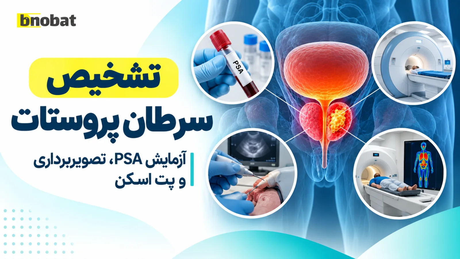 تخیص سرطان پروستات